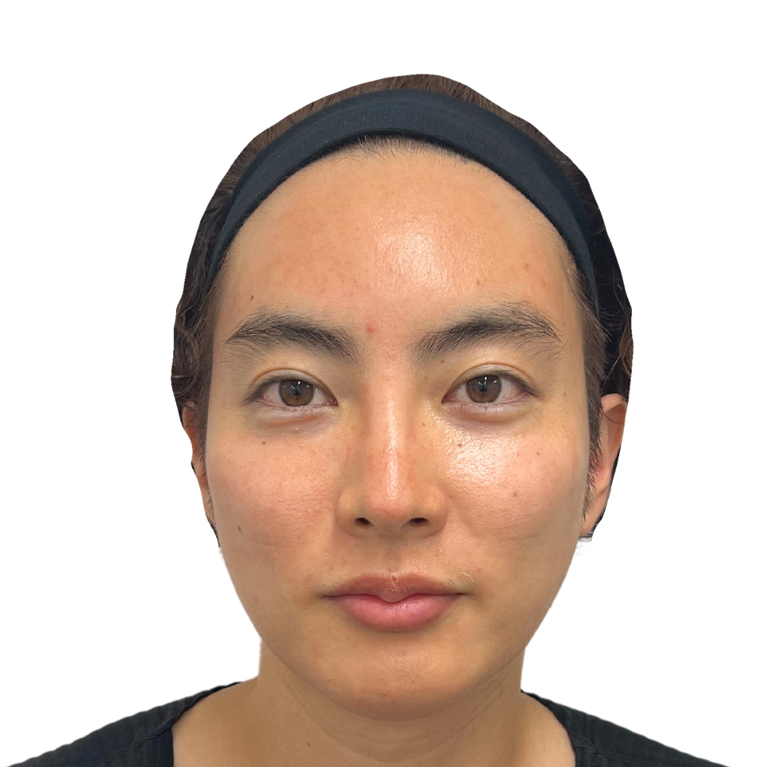 マヌカフェイシャル（ダーマペン4）